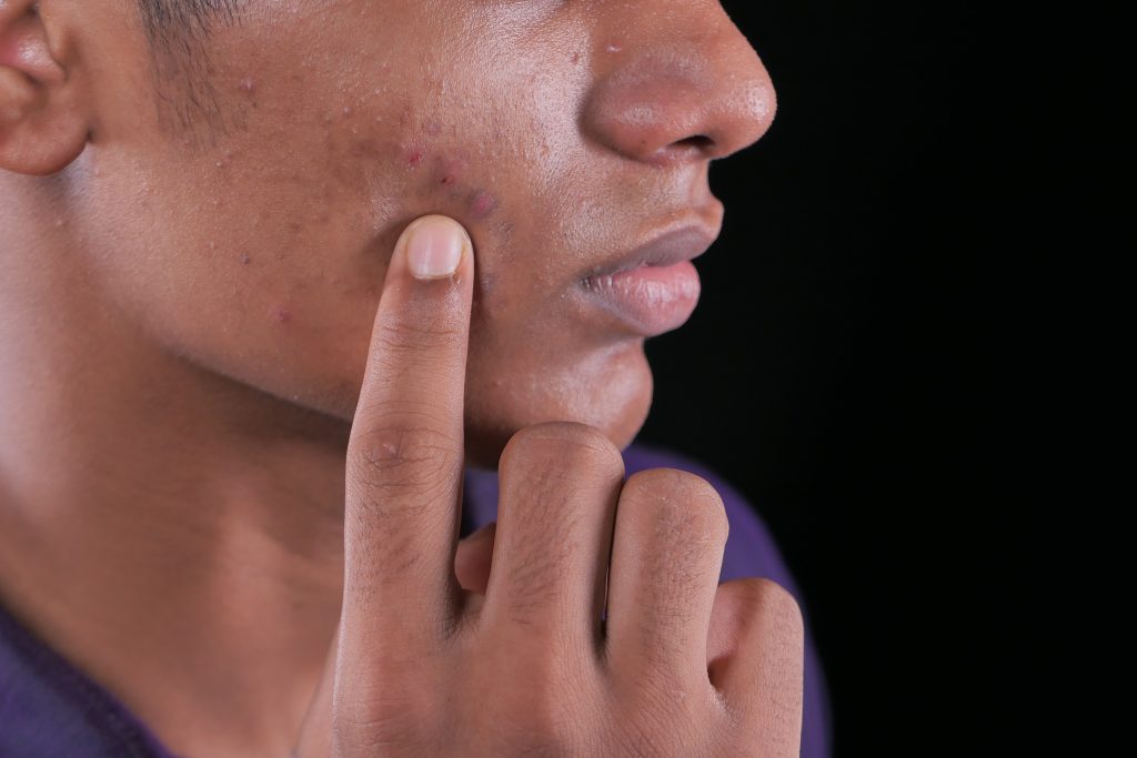 Acne Scar Revision in New BEL Road